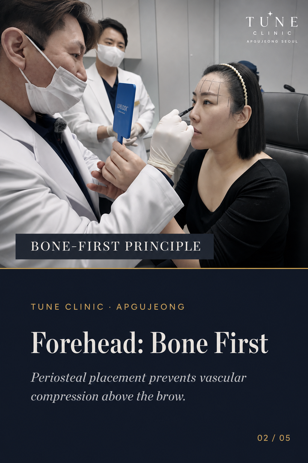 Forehead: Bone First — Periosteal placement prevents vascular compression above the brow.
