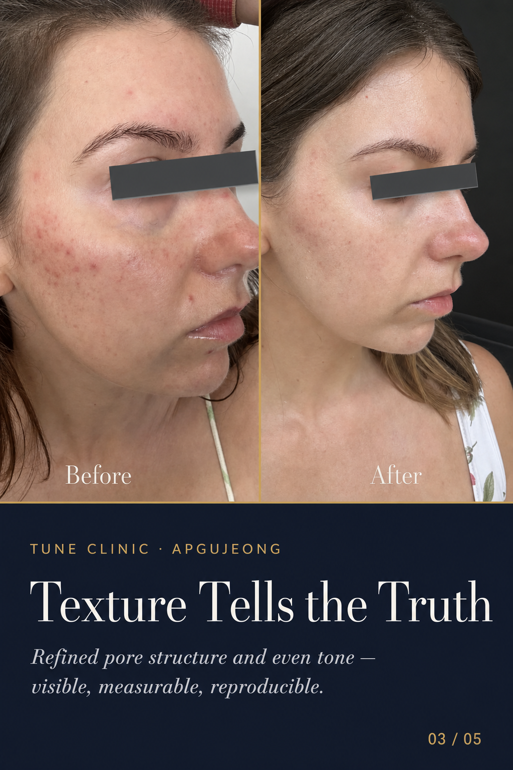 Texture Tells the Truth — Refined pore structure and even tone — visible, measurable, reproducible.