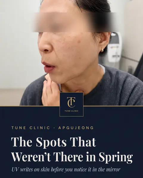 Pico Toning for Melasma and Summer Pigment: What Actually Works?