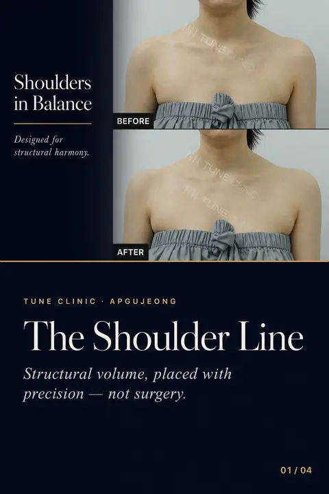 Shoulder and Hip Filler: Anatomy, Volume Maps, and the Right Cannula