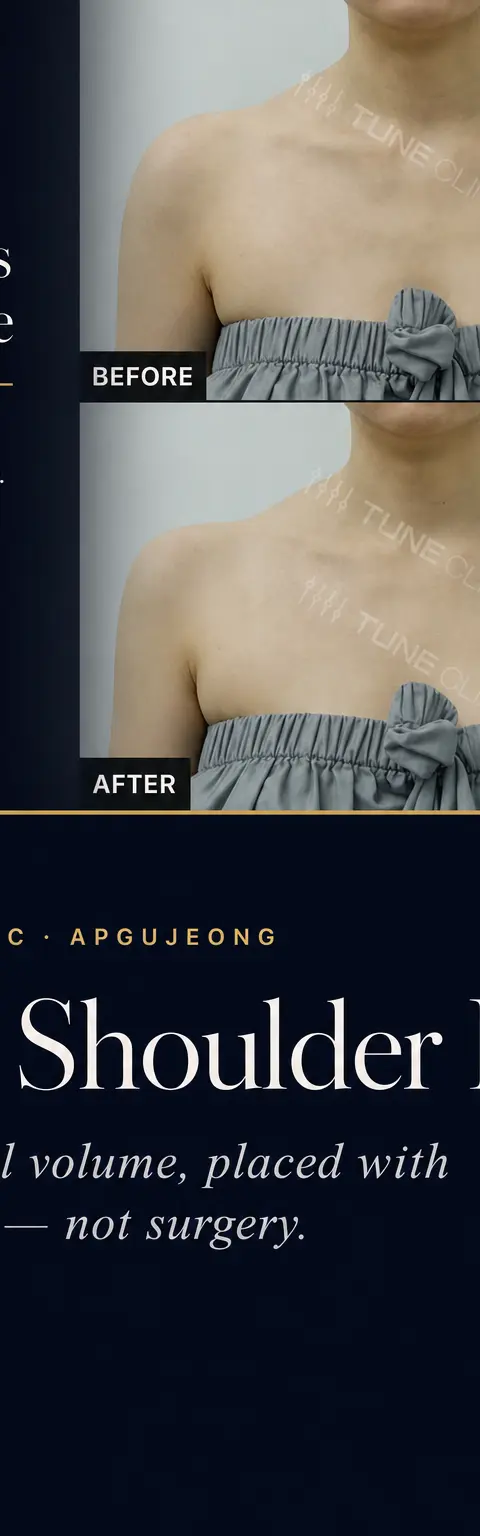 Shoulder and Hip Filler: Anatomy, Volume Maps, and the Right Cannula