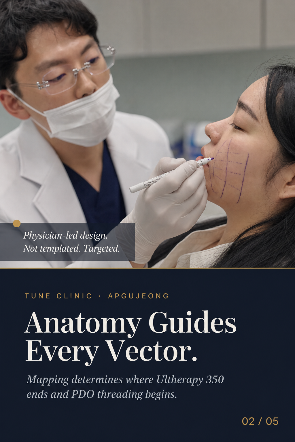 Anatomy Guides Every Vector. — Mapping determines where Ultherapy ends and PDO threading begins.