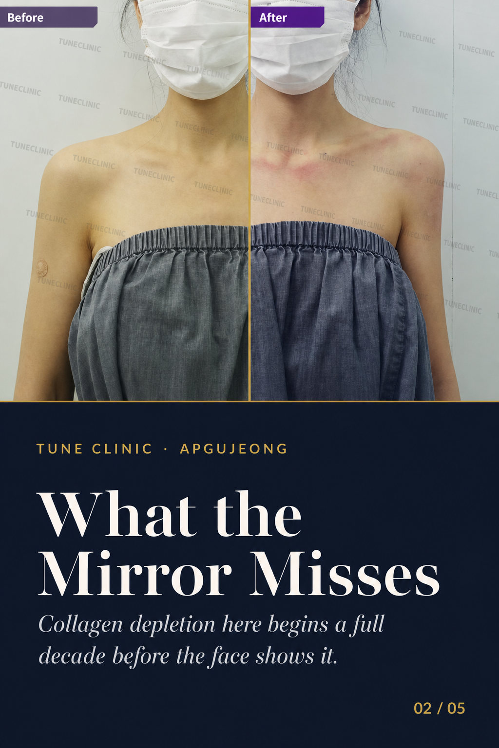 What the Mirror Misses — Collagen depletion here begins a full decade before the face shows it.